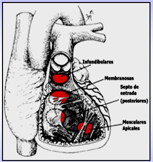 cardiopatias_congenitas/anatomia_comunicacion_interventricular