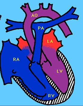 cardiopatias_congenitas/anomalia_ebstein_fisiopatologia