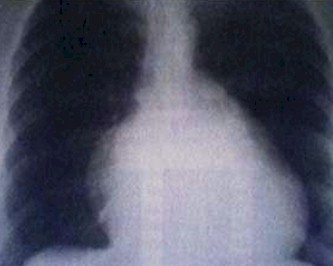 cardiopatias_congenitas/anomalia_ebstein_radiografia cardiopatias_congenitas/anomalia_ebstein_radiografia