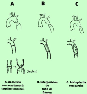 cardiopatias_congenitas/cirugia_coartacion_aortica cardiopatias_congenitas/cirugia_coartacion_aortica
