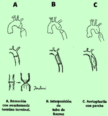 cardiopatias_congenitas/cirugia_coartacion_aortica