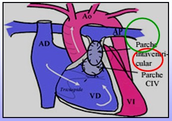 cardiopatias_congenitas/cirugia_tetralogia_Fallot