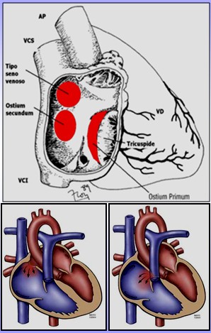 cardiopatias_congenitas/clasificacion_comunicacion_interauricular