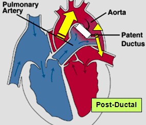 cardiopatias_congenitas/coartacion_aortica_postductal
