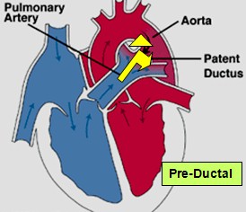 cardiopatias_congenitas/coartacion_aortica_preductal