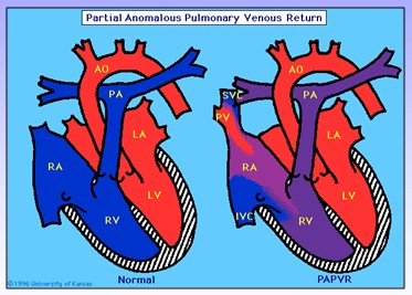 cardiopatias_congenitas/drenaje_venoso_anomalo_parcial cardiopatias_congenitas/drenaje_venoso_anomalo_parcial