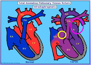 cardiopatias_congenitas/drenaje_venoso_anomalo_total_infradiafragmatico