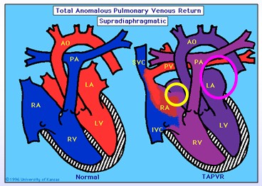 cardiopatias_congenitas/drenaje_venoso_anomalo_total_supradiafragmatico cardiopatias_congenitas/drenaje_venoso_anomalo_total_supradiafragmatico