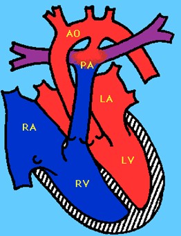 cardiopatias_congenitas/ductus_arteriosus_persistente