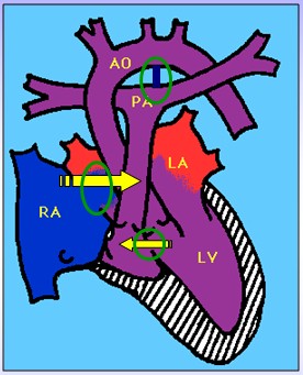 cardiopatias_congenitas/fisiopatologia_atresia_tricuspidea