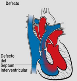 cardiopatias_congenitas/fisiopatologia_comunicacion_interventricular_CIV.