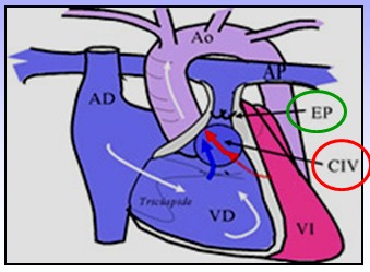 cardiopatias_congenitas/fisiopatologia_tetralogia_Fallot