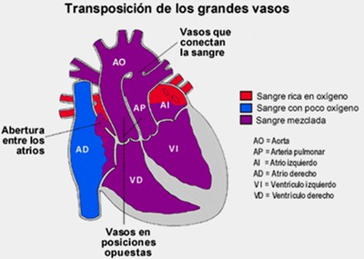cardiopatias_congenitas/fisiopatologia_transposicion_grandes_arterias cardiopatias_congenitas/fisiopatologia_transposicion_grandes_arterias