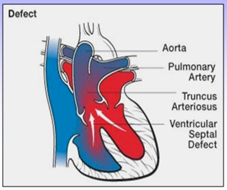 cardiopatias_congenitas/fisiopatologia_tronco_arterioso_comun cardiopatias_congenitas/fisiopatologia_tronco_arterioso_comun