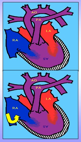 cardiopatias_congenitas/fisiopatologia_ventriculo_unico cardiopatias_congenitas/fisiopatologia_ventriculo_unico