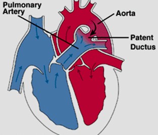 cardiopatias_congenitas/flujo_ductus_persistente