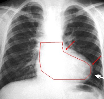 cardiopatias_congenitas/radiografia_tetralogia_Fallot.