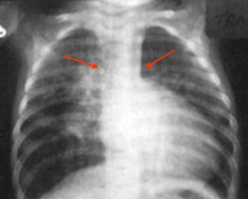 cardiopatias_congenitas/radiografia_transposicion_grandes_arterias cardiopatias_congenitas/radiografia_transposicion_grandes_arterias