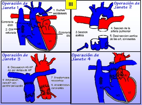 cardiopatias_congenitas/transposicion_arterias_Jatene cardiopatias_congenitas/transposicion_arterias_Jatene