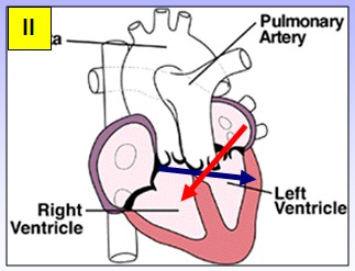 cardiopatias_congenitas/transposicion_arterias_Mustard cardiopatias_congenitas/transposicion_arterias_Mustard