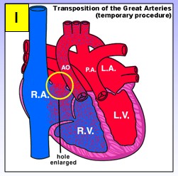 cardiopatias_congenitas/transposicion_arterias_atrioseptostomia cardiopatias_congenitas/transposicion_arterias_atrioseptostomia