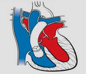 cardiopatias_congenitas/tratamiento_tronco_arterioso_comun cardiopatias_congenitas/tratamiento_tronco_arterioso_comun