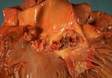 endocarditis_infecciosa/aortografia_embolismo_septico endocarditis_infecciosa/aortografia_embolismo_septico