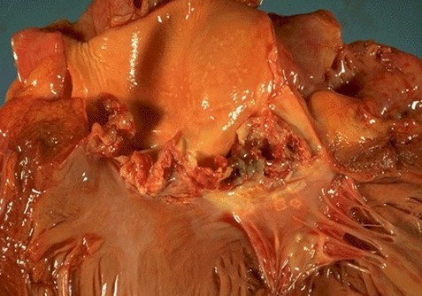 endocarditis_infecciosa/aortografia_embolismo_septico