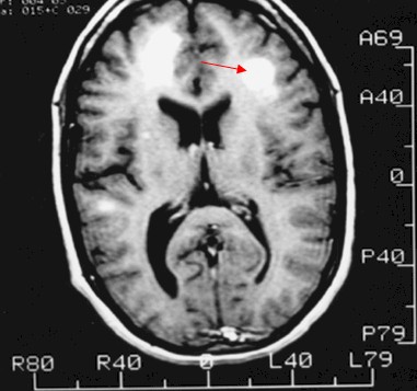 endocarditis_infecciosa/embolismo_septico_cerebral. endocarditis_infecciosa/embolismo_septico_cerebral.