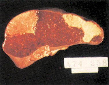 endocarditis_infecciosa/embolismo_septico_hepatico endocarditis_infecciosa/embolismo_septico_hepatico