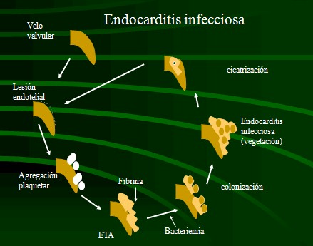 endocarditis_infecciosa/formacion_vegetaciones endocarditis_infecciosa/formacion_vegetaciones