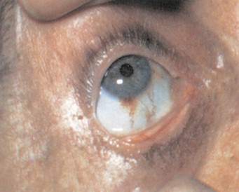 endocarditis_infecciosa/hemorragia_conjuntival_septica