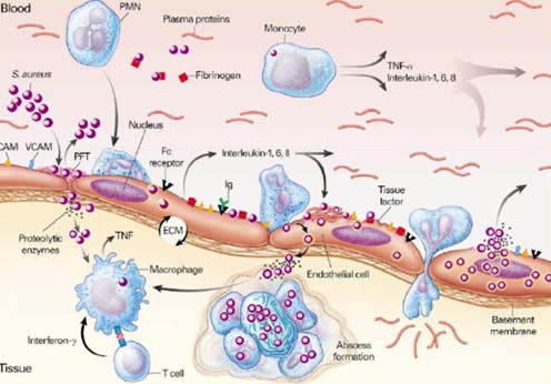 endocarditis_infecciosa/histologia_endocarditis_septica endocarditis_infecciosa/histologia_endocarditis_septica