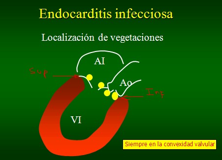 endocarditis_infecciosa/localizacion_vegetaciones_verrugas