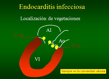 endocarditis_infecciosa/localizacion_vegetaciones_verrugas endocarditis_infecciosa/localizacion_vegetaciones_verrugas