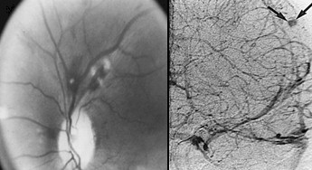 endocarditis_infecciosa/manchas_Roth endocarditis_infecciosa/manchas_Roth