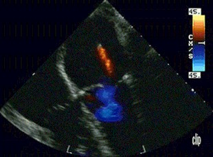 endocarditis_infecciosa/signos_ecograficos_ecocardiograficos endocarditis_infecciosa/signos_ecograficos_ecocardiograficos