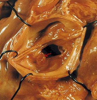 endocarditis_infecciosa/verruga_endocarditis_protesica endocarditis_infecciosa/verruga_endocarditis_protesica