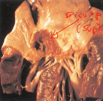 endocarditis_infecciosa/vegetaciones_endocarditicas endocarditis_infecciosa/vegetaciones_endocarditicas
