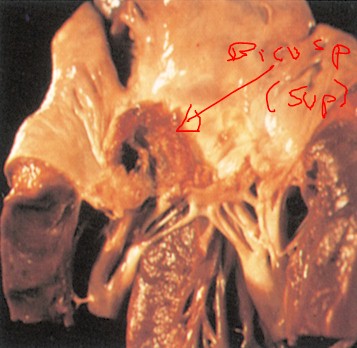 endocarditis_infecciosa/vegetaciones_endocarditicas