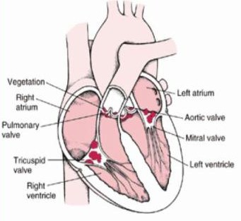 endocarditis_infecciosa/vegetaciones_verrugas