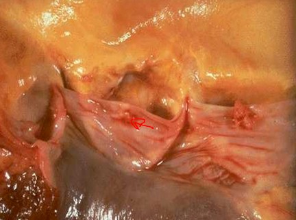 endocarditis_infecciosa/vegetacion_endocarditis_aortica endocarditis_infecciosa/vegetacion_endocarditis_aortica