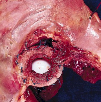 endocarditis_infecciosa/embolismo_septico endocarditis_infecciosa/embolismo_septico