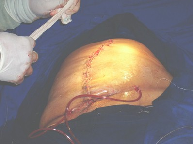 hernia_umbilical_gigante/cirugia_drenaje_drenajes