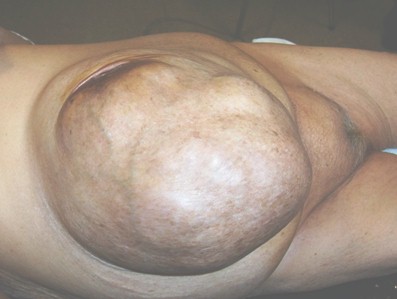 hernia_umbilical_gigante/hernia_ombligo_enorme