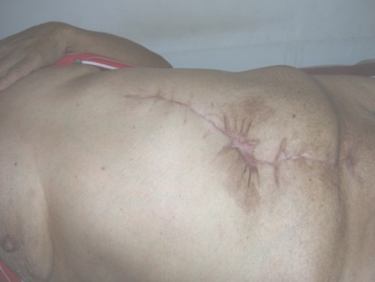 hernia_umbilical_gigante/herniorrafia_cicatriz hernia_umbilical_gigante/herniorrafia_cicatriz