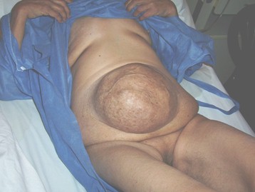 hernia_umbilical_gigante/ombligo_exploracion_fisica