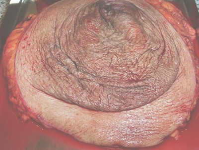 hernia_umbilical_gigante/ombligo_extirpada_herniorrafia