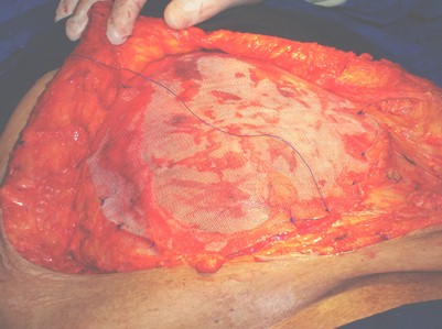 hernia_umbilical_gigante/ombligo_herniorrafia_diseccion