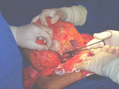 hernia_umbilical_gigante/ombligo_herniorrafia_extirpacion